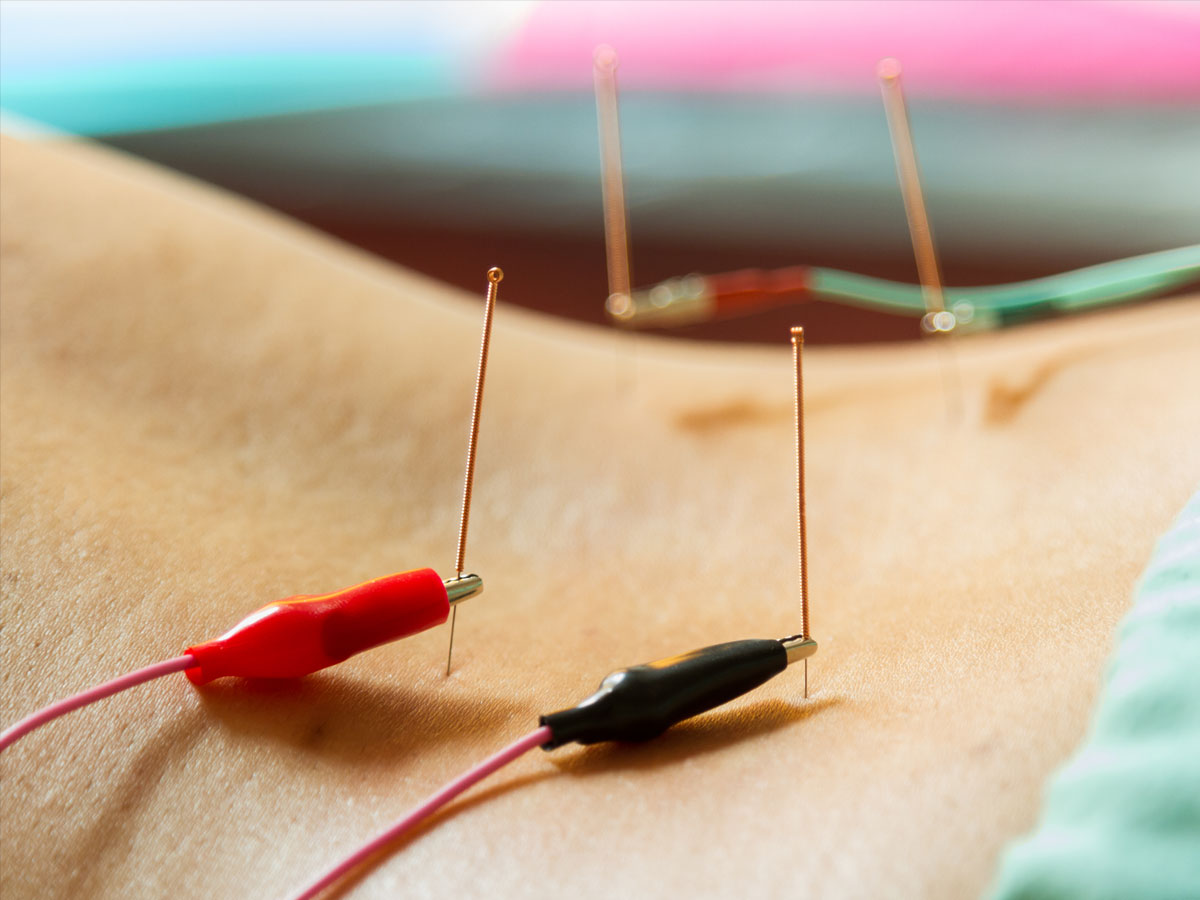 Agujas de acupuntura conectadas a electrodos en una sesión de electropuntura