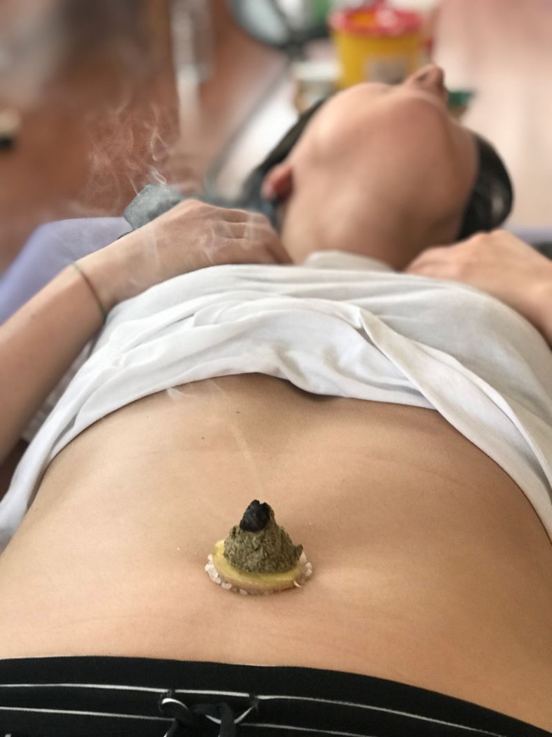 Cono de artemisa en una sesión de moxibustión