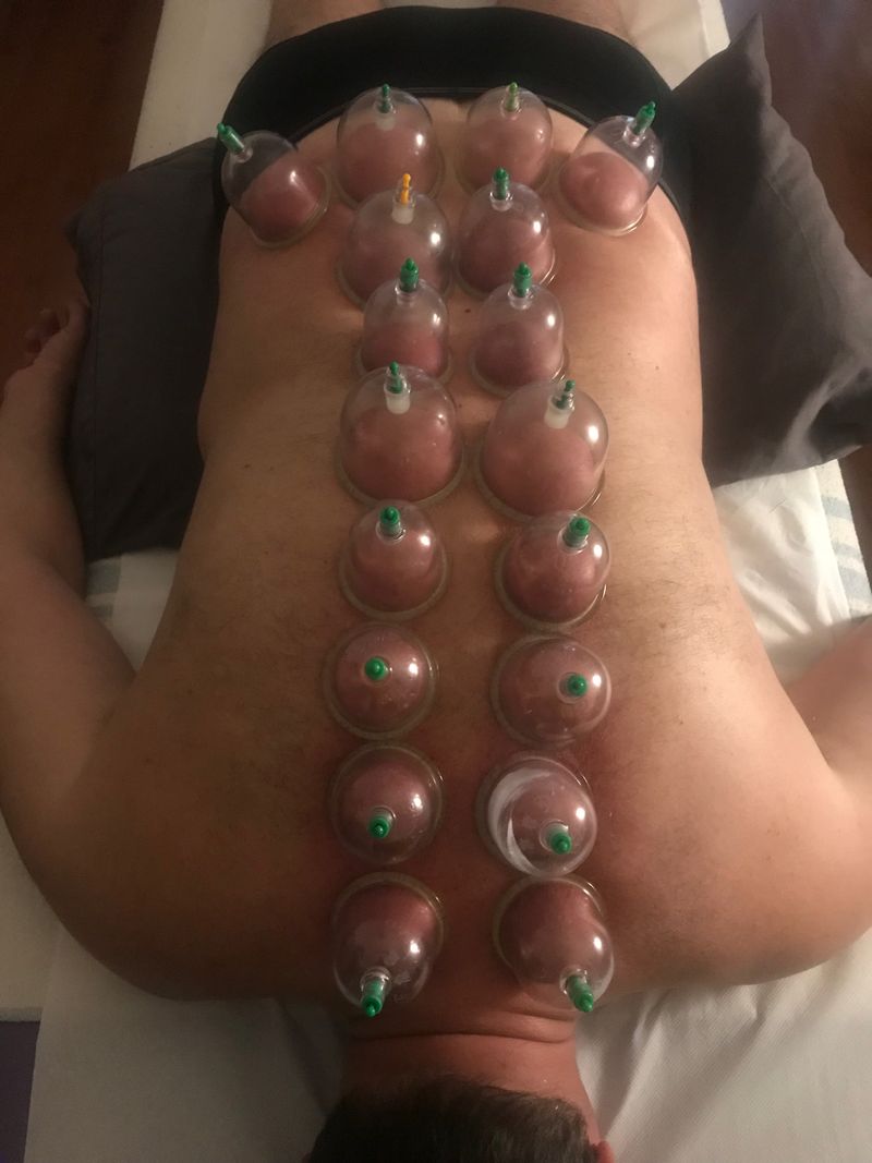 Ventosas aplicadas en la espalda